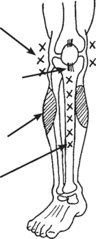 Front view of a human leg from above the knee to the foot, arrows and letter "x" note characteristics.