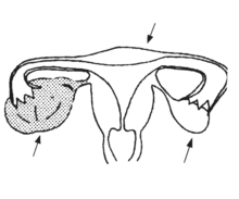 an ovary with cysts