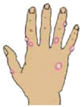 Alt text= a hand covered with fluid filled bumps
