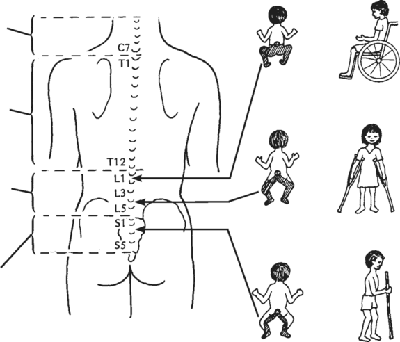 parts of the backbone and how much paralysis the child will have