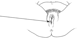 rightalt=illustration of the above: a small sore outside the vagina