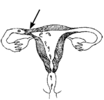 a woman's reproductive parts, with scarring in the tube that keeps the egg from being fertilized.