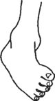 Curved foot due to contracture.