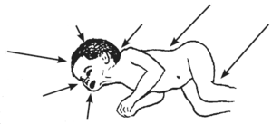 signos de meningitis