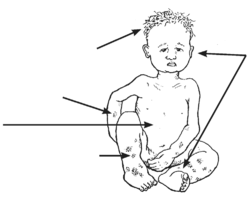 A bigger, less thin child with light, thin hair, a swollen belly and ankles, and dark patches on the skin