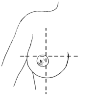 Pendulous breast in supine position without microshell immobilization.