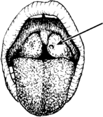 Illustration of swollen tonsils