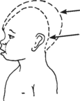 comparison of head sizes that are typical and smaller than usual.