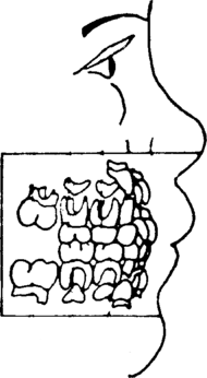 a child's teeth, with upper and lower molars labeled.