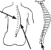 a spine with scoliosis