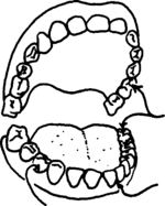 a person's teeth, showing 3 problem areas.