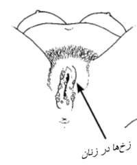 whitish bumps on the skin near the opening to a woman's vagina.