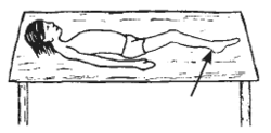 arrow points to a child's contracture